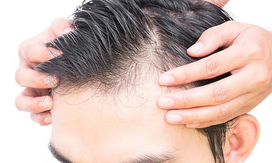 FUE Hair Transplant – What Should You Expect?